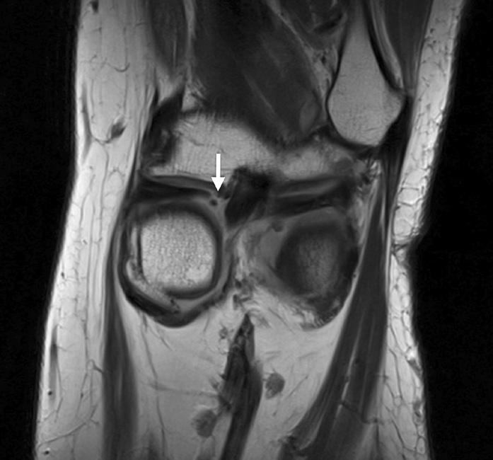 360 Ji-Hoon Bae and Han-Ju Kim A B C Figure 1. (A) Coronal magnetic resonance (MR) image showing the medial meniscus posterior root tear (arrow).