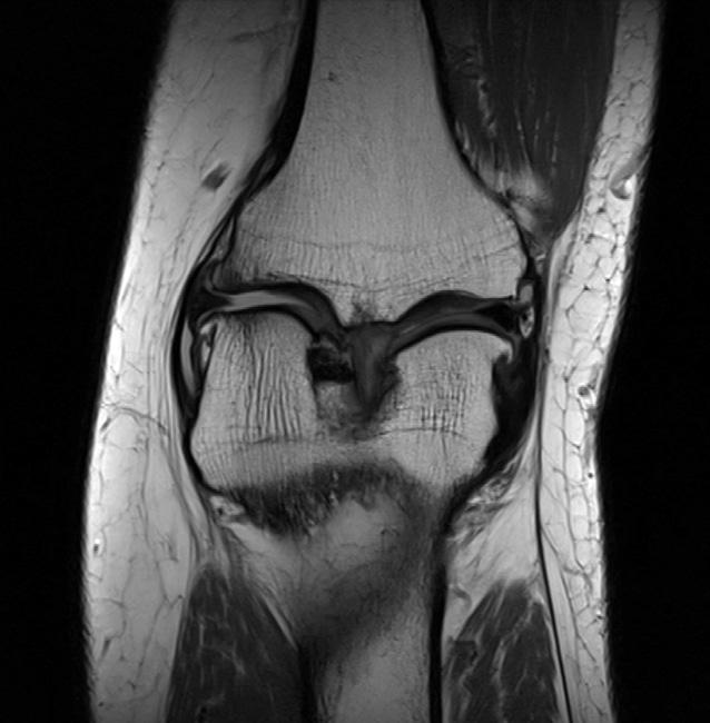 (C) Sagittal MR image showing effusion and a full thickness cartilage defect in the weight bearing area of the medial femoral condyle and medial tibia plateau. 개선을위해보존적치료를먼저시행할수있다.