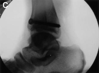 Radiographs show anterior approach procedure using counter pushing technique.