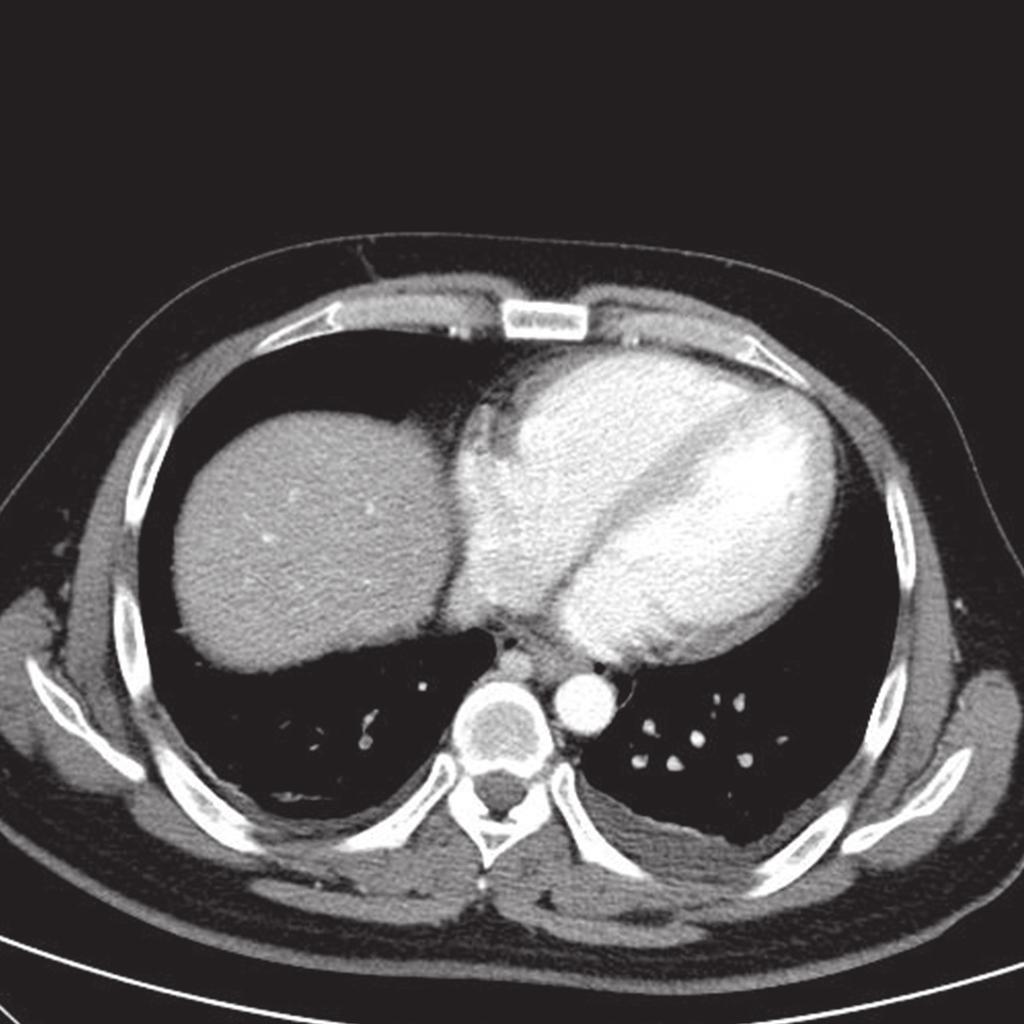 DKA with Emphysematous Gastritis 357 A B Fig. 3. A. Follow-up thorax CT showed resolution of pneumomediastinum (arrow). B. Follow-up abdomen CT showed resolution of stomach wall (arrow), and portal venous air.
