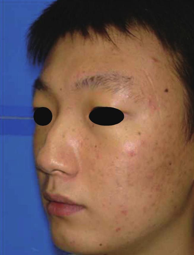 Facial profiles of case 1, S-shaped deviated nasal deformity is shown on the preoperative