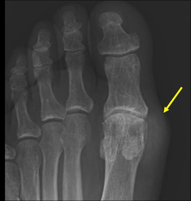 - 대한내과학회지 : 제 83 권제 2 호통권제 624 호 2012 - A Figure 19. Gout. (A) Radiograph shows soft tissue swelling (arrow) of the medial portion of the 1st metatarsal head with adjacent bone erosion.