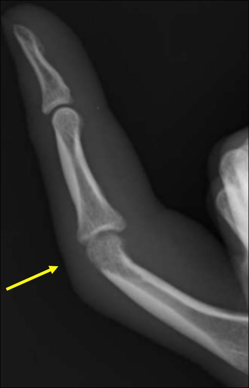 bone erosion (arrow) of the PIP joint.