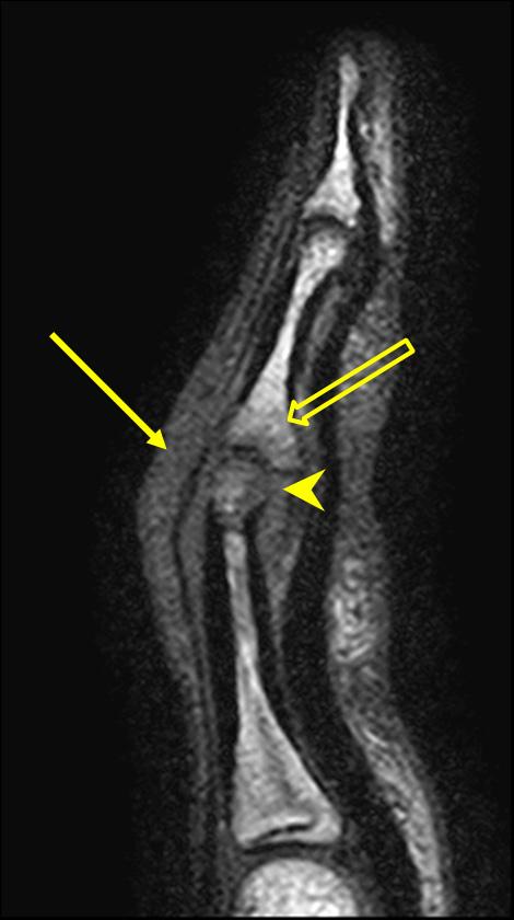 After contrast infusion, fat suppressed T1-weighted image shows signal enhancement of the proximal phalangeal head and periarticular soft tissue sparing mid