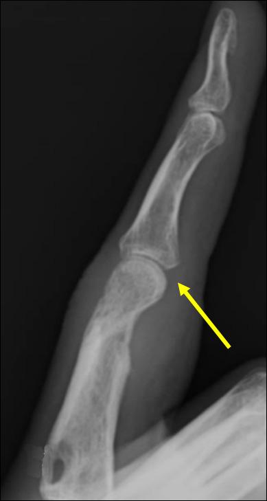 The joints space of the PIP joint of the finger is relatively preserved (arrow) (C) Ultrasonography of the volar portion of the PIP joint shows effusion (arrow) in the joint and large erosion of
