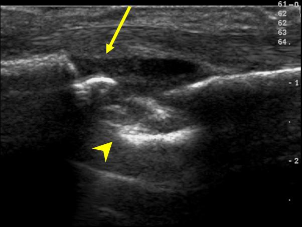 Radiograph of a hand shows joint space narrowing, bone erosion (arrow heads) and periarticular soft tissue swelling (arrow) in pancompartment of the wrist and metacarphophalangeal and proximal