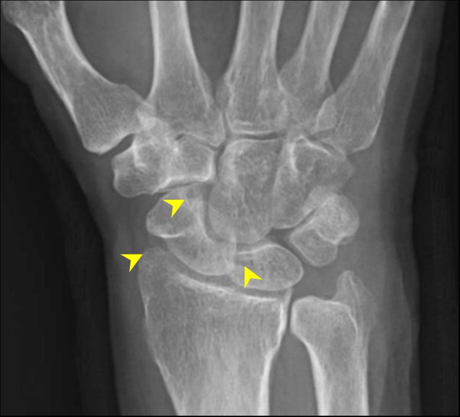 - Sung Hye Koh. Imaging of arthritis - A B C Figure 6.