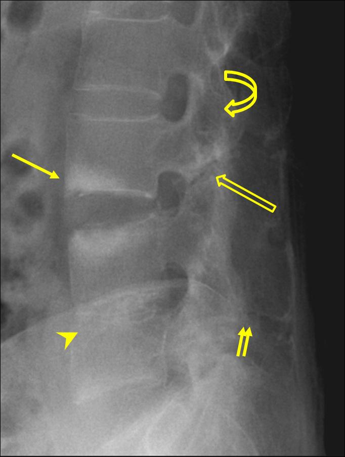 Ankylosing spondylitis of L-spine.