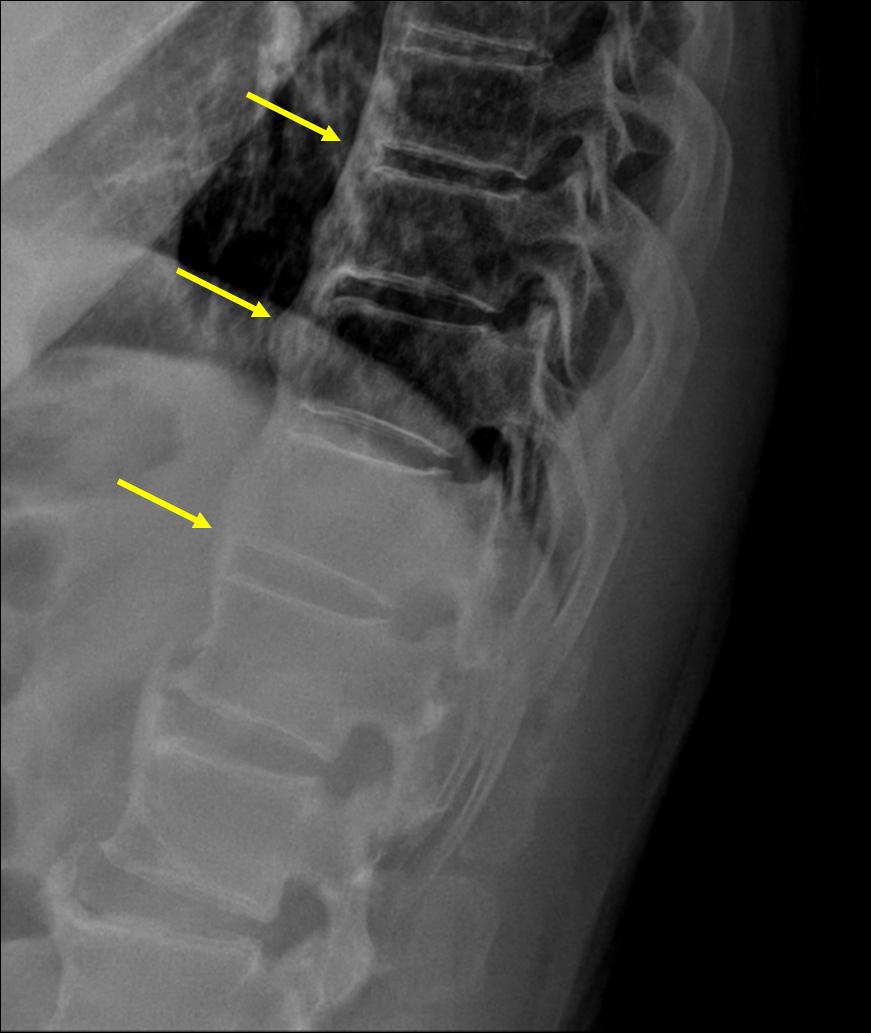 DISH (Diffuse idiopathic skeletal hyperostosis) of thoracolumbar spine.