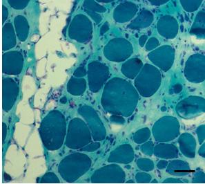 (A) H&E stain shows fiber size variation and few degenerating fibers.