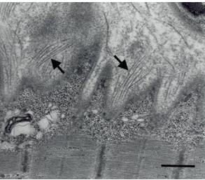 deficient in sarcolemma while it is normally present in interstitium.