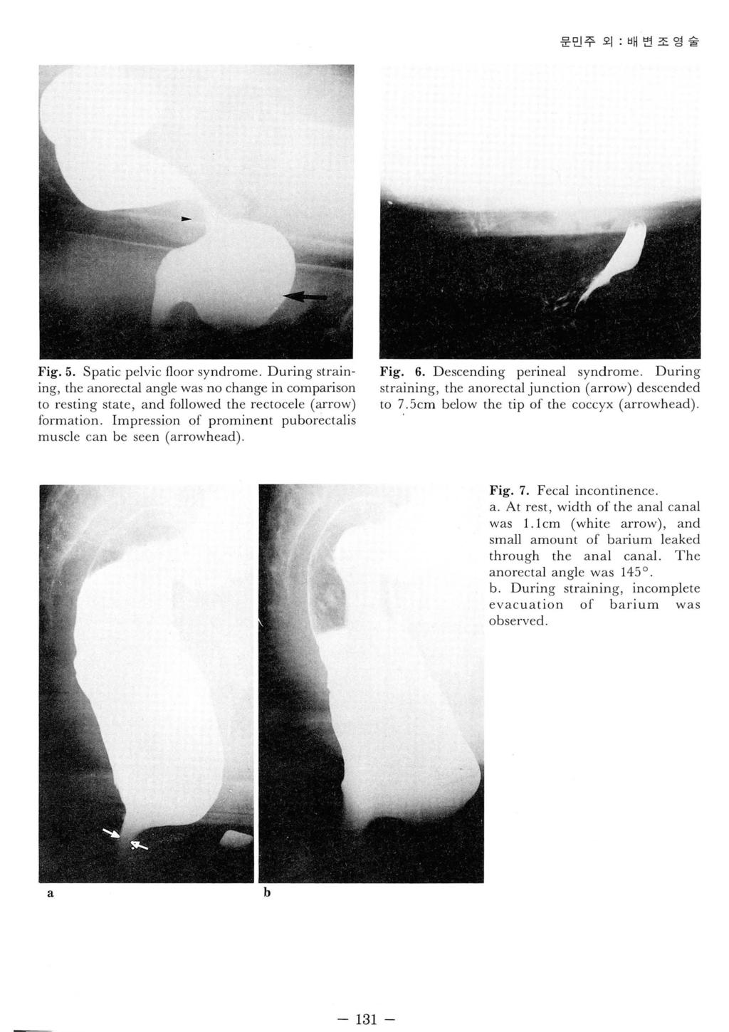 - 131 - 문민주외 : 배번조영술 Fig.5. Spatic pelvic floor syndrome. During straining, the anorectal angle was no change in comparison to resting state, and followed the rectocele (arrow) formation.
