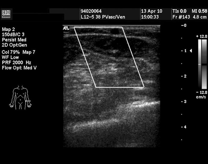 대흉외지 2010;43:764-768 Fig. 2. (A) Preoperative Doppler sonography view showing dilated vein.