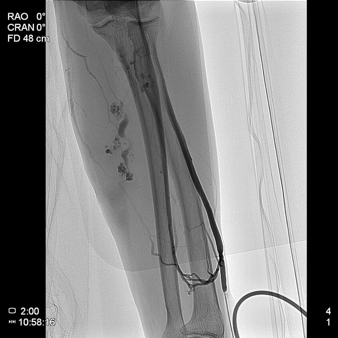 (D) Preoperative upper extremity venogram view: showing dilated veins with delayed angio pattern and flower-blooming like