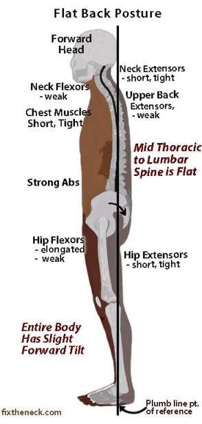 Anatomical Description 1. 편평등 (Flat Back Syndrome) 이란?