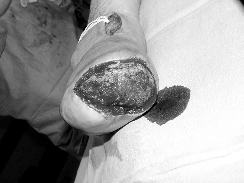 (C, D) Foot wound coverage with dorsal pedal vessel based on myocutaneous free flap.