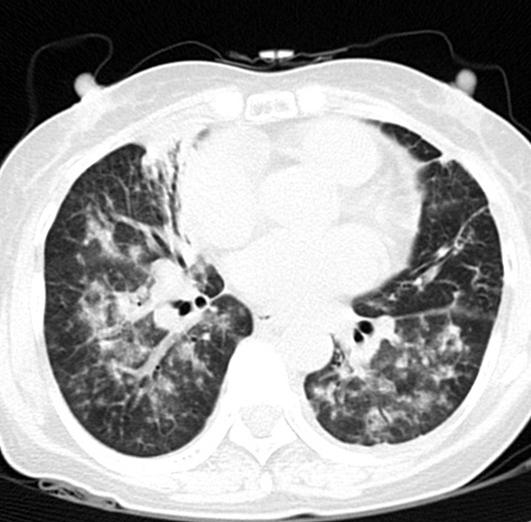 After hospitalization, massive hemoptysis from RML