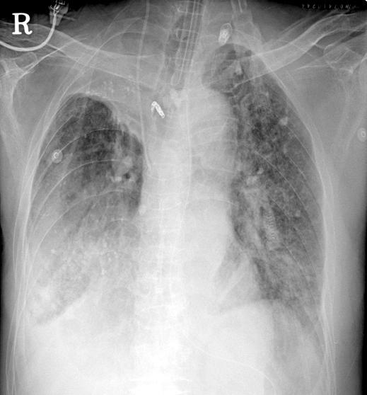 JY Moon et al: Usefulness of bronchial blockers in massive hemoptysis cases 9 42 10 /L로 범혈구감소증이었고, C반응단백은 198.