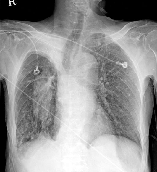 내원하여 촬 영한 흉부 단순촬영에서는 양측 폐에서 다발성 경화와 간 유리 음영, 사이질 음영의 증가가 관찰되었다(Figure 2D).