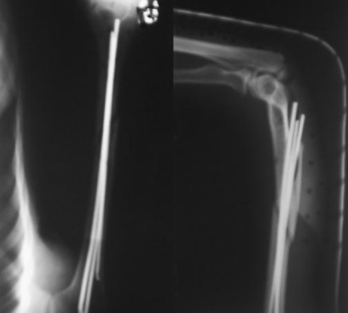 Expose the distal humerus shaft with a triceps longitudinal splitting