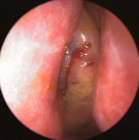 김동현외 S * MT Fig. 1. Nasal endoscopic finding () shows a whitish smooth mass (*) between the nasal septum & middle turbinate.