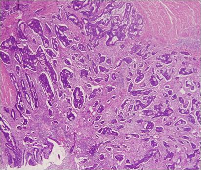 In the pathology, the tumor was composed of numerous moderately differentiated glands with an infiltrative growth pattern (H&E 100) (B). B Figure 4. The PET-CT shows about a 2.