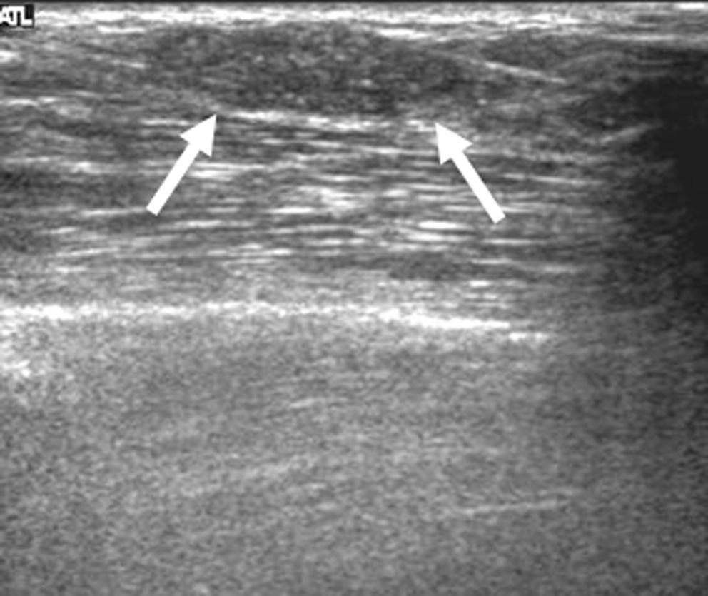 Two malignant cases showing the interobserver variability. A. Transverse sonogram in a 46-year-old woman having a screening-detected mass.