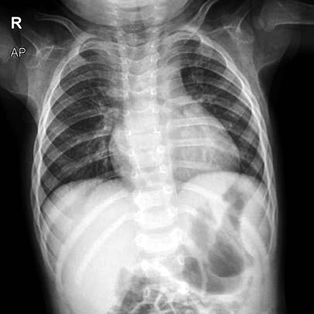 월에호흡기세포융합바이러스 (respiratory syncytial virus) 에의한모세기관지염을앓았던것외에특이사항없었으며, 가족력에서도특이사항없었다. 본원방문당시환자의활력징후는혈압 101/76 mmhg, 호흡수 28회 / 분, 심장박동수 130회 / 분, 체온 36.9 C, 맥박산소포화도 99% 였으며, 의식은명료하고전반적으로아파보이는상태였다.