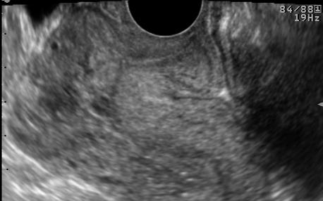 16 4) Placental-uterine wall interface 상대적으로 decidua가적은자궁의부분, 즉하부절, 기 왕수술부위등에태반이착상하기때문에자궁근층으로침투가용이하여유착태반이잘발생한다는가설을뒷받침하는초음파소견으로 Wong 등 21 은임신 6주의과거제왕절개분만력이있는산모에서