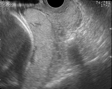 1) 태반내반월상열공 (Intraplacental lacunae) 일반적으로임신중반이후이차원초음파검사상매우분명한, 다수의저에코또는무에코를가진 space, 즉 placental