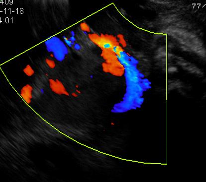 2) Clear zone 소실 (disruption of placental-uterine wall interface) 정상적인임신에서는자궁근층과태반사이는매우낮은에코의검은선으로보이는 decidua basalis