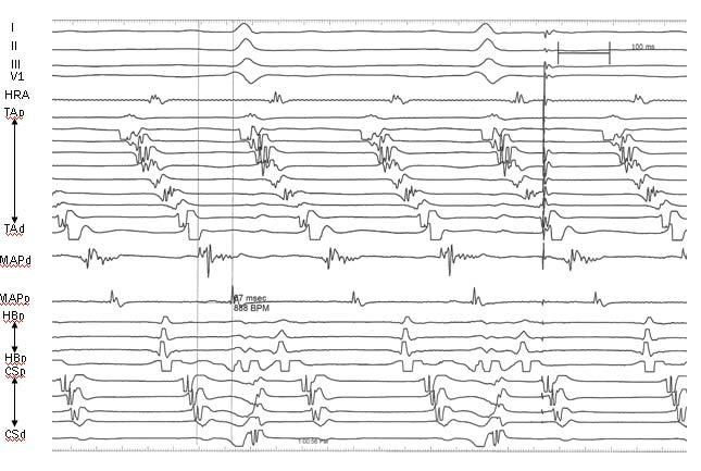 - 대한내과학회지 : 제 76 권제 1 호통권제 581 호 2009 - Figure 4. Surface lead electrocardiograms and intracardiac electrograms produced during induced tachycardia.