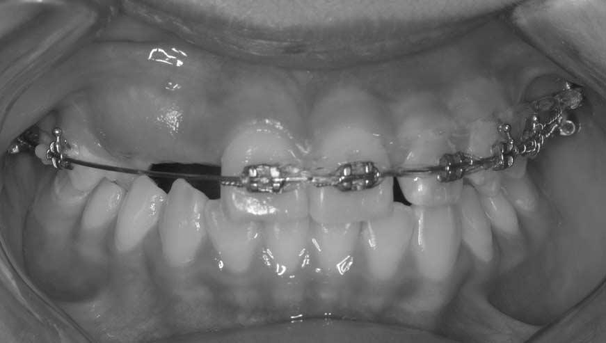 Intraoral pictures taken at the first visit. Fig. 2.