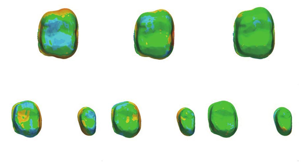 A B RMS vlue (µm) RMS vlue (µm).00 Single utment Bridge utment.00 Single utment Bridge utment Fig. 4. Comprison of ccurcy ccording to utment type. (A) Trueness, (B) Precision.