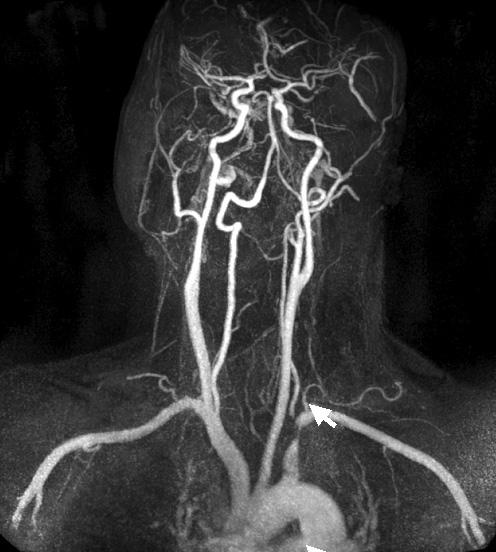 Won-Back Kim, et al: A Case of Successful Steal Syndrome Who Found Incidentally Significant Interarm Blood Pressure Difference 은차이가있을수있으나그차가심할수록동맥경화증으로인한말초혈관질환을시사하고, 심혈관계질환의이환율과사망률이높아진다.