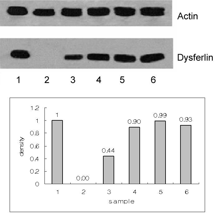 Figure 8. Western blotting in PM & DM patients for dysferlin. Graph shows the relative density. 1: Normal control, 2: dysferlinopathy, 3/4: PM, 5/6: DM. (Average of relative density in PM & DM: 0.