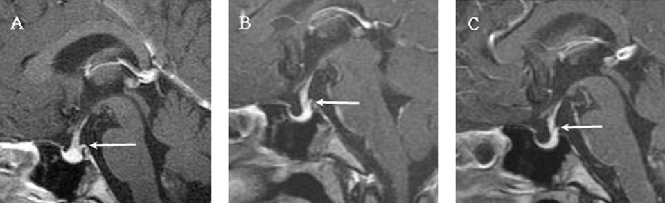 Fig. 1. T1-weighted contrast enhanced sagittal images of sella magnetic resonance images taken initially, a year later, and two years later. (A) Initial images reveal a thickened pituitary stalk (3.