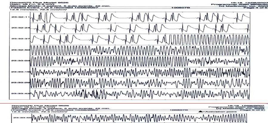 Figure 3. Ventricular fibrillation recorded by using implantable loop recorder during sleep in a 27 year-old male patient with unexplained recurrent syncopal episodes.