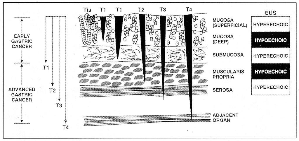 분과 27 <Sleisenger's Gastrointestinal and liver disease, 7th edition, Fig 44-7, 840> 조기위암은임파선전이여부와상관없이점막하층까지로국한된경우 표 1.