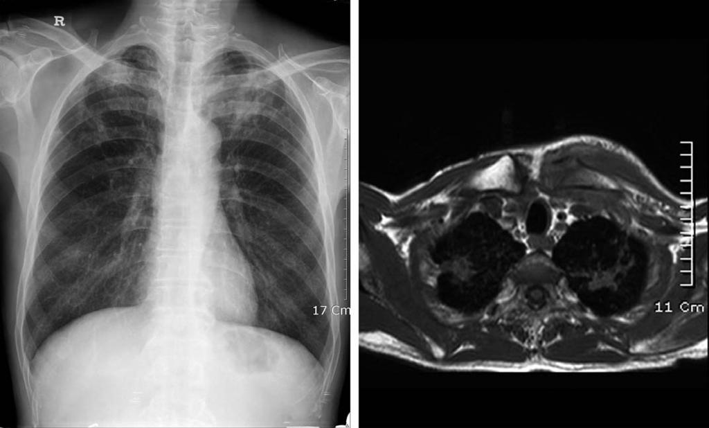 대한견 주관절학회지제 11 권제 1 호 A B Fig. 1. (A) Multifocal ill defined and irregular nodular and patchy increased density in both upper lobes on chest X-ray.