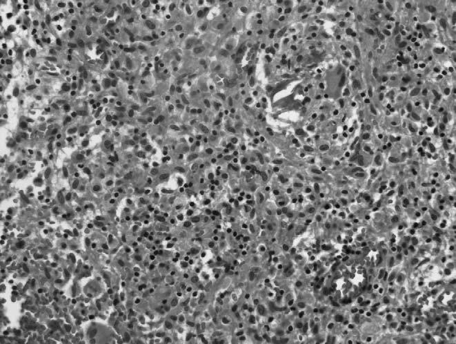 The study demonstrates focal caseous necrosis and Langerhans giant cell. 흉쇄관절에발생되는결핵성관절염은전체결핵관절염의 1~2% 정도로매우드물어그에대한증례보고도드물며 1,4) 아직까지국내에보고된논문은없다.