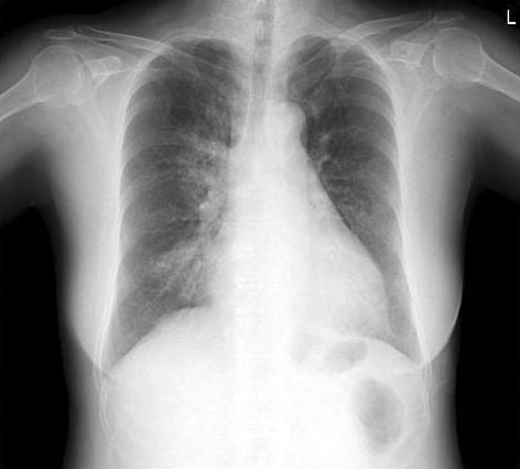 대한수혈학회지 : 제 18 권제 3 호 Fig. 1. (A) Initial chest X-ray shows consolidation in right hilar area and right middle lung field.