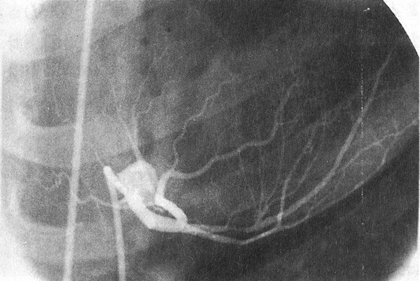 A A B B Fig. 1. A) The target lesion of left anterior descending artery was shown.