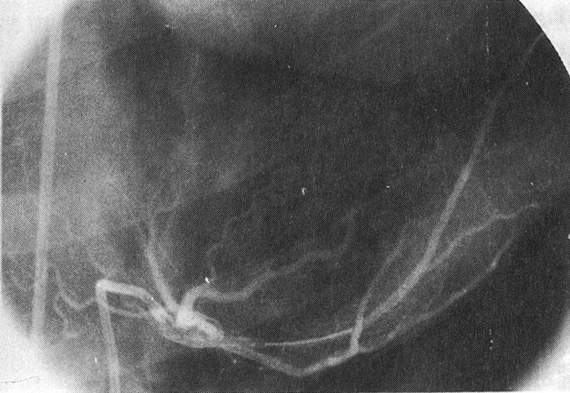 A) Stent was placed immediately after local NO donor delivery at left anterior descending artery. B) Follow-up coronary angiogram was performed at 48 hours after local NO donor delivery and stenting.