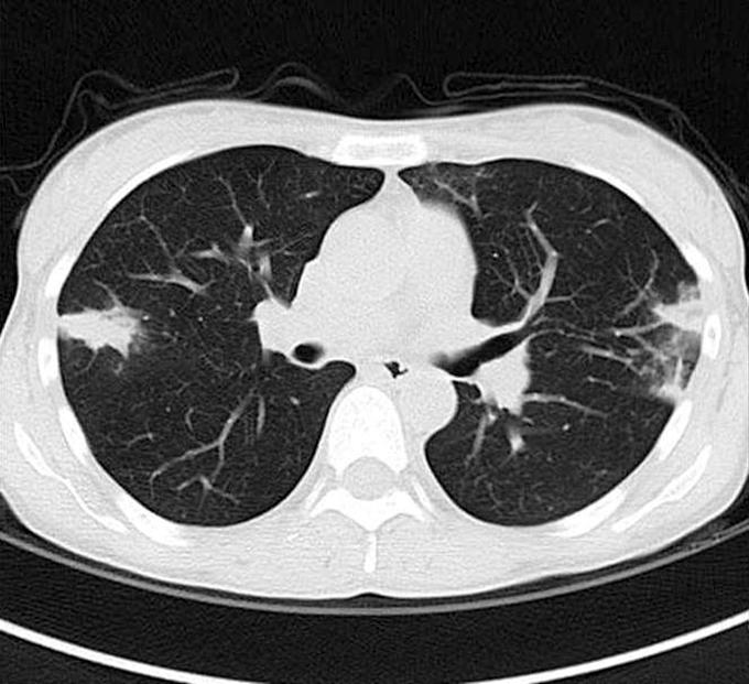 대한류마티스학회지제 16 권제 4 호 2009 Fig. 2. The chest HRCT shows multiple peripheral macronodules and patchy consolidation in both the mid-lung and lower lung field. dl였으며, tuberculin skin test는음성이었다.