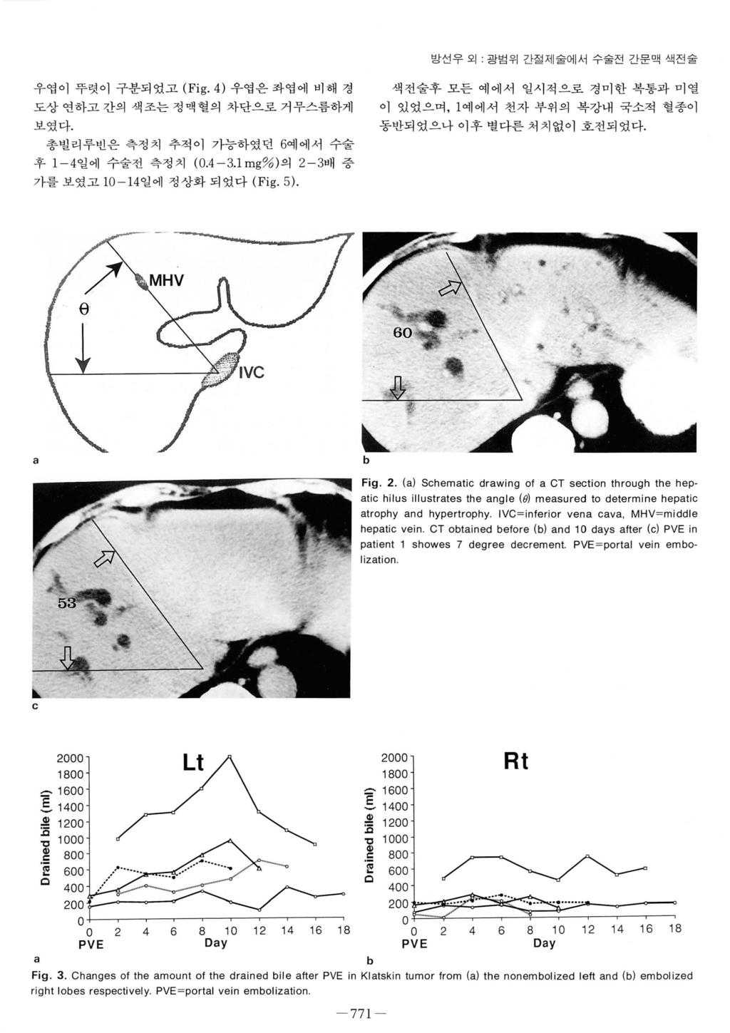 방선우외, 광범위간절제술에서수술전간문맥색전술 우엽이뚜렷이구분되었고 (Fig. 4) 우엽은좌엽에비해경도상연하고간의색조는정맥혈의차단으로거무스름하게보였다. 총빌리루빈은측정치추적이가능하였던 6예에서수술후 1-4 일에수술전측정치 (0.4-3.1 mg% ) 의 2-3배증가를보였고 10-14일에정상화되었다 (Fig. 5).