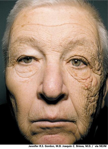 Photoaging effect of UV The patient reported that he had driven a delivery truck for 28years.