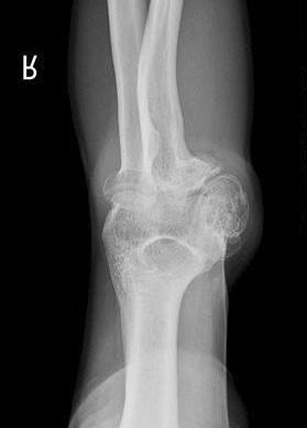 Hyun Kyu Yu, et al. Cubital Tunnel Syndrome Caused by Osteochondroma 관절부위에티넬징후 (Tinel sign) 가있었으며우측주관절내측부위에 5 5 cm 크기의무통성의단단한종괴가만져졌다 (Fig. 1).