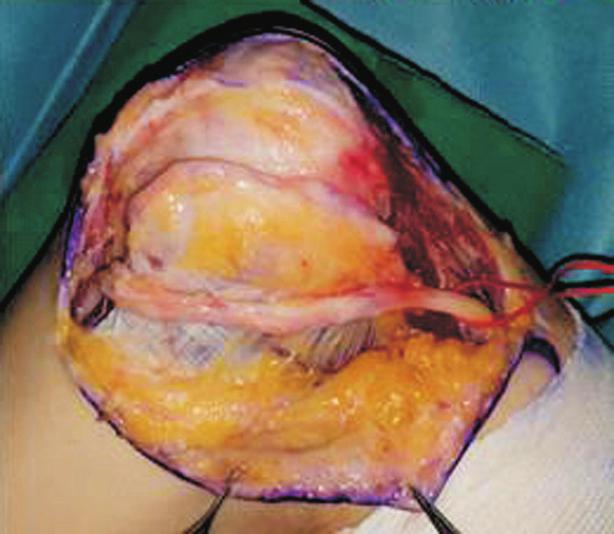 The osteochondroma was finded under the ulnar nerve and covered by cartilage cap. Fig.