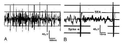 Figure 6. Typical recording of the spontaneous electrical activity(sea)and spikes recorded from an active locus of a trigger point at two dif - ferent sweep speeds.